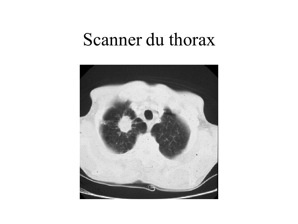 Scanner du thorax