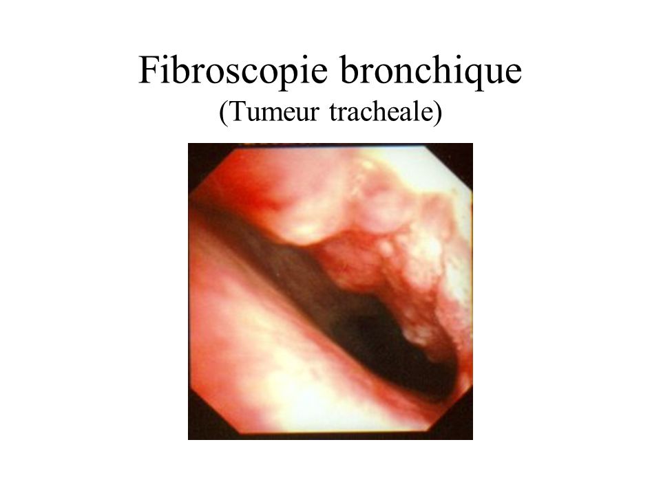 Fibroscopie bronchique (Tumeur tracheale)