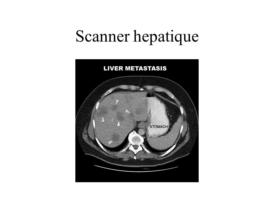 Scanner hepatique