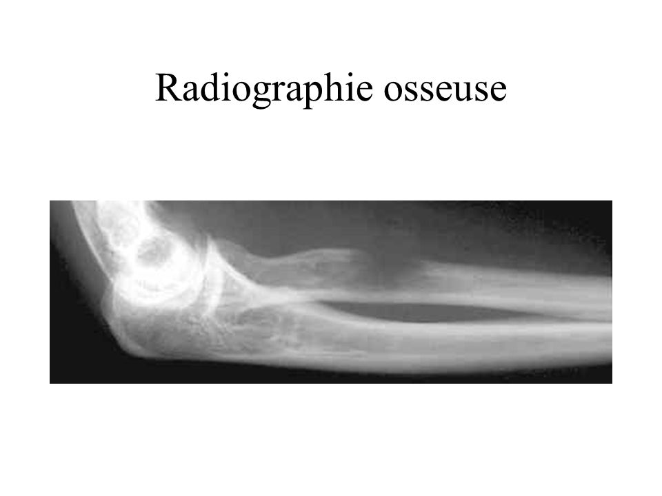 Radiographie osseuse