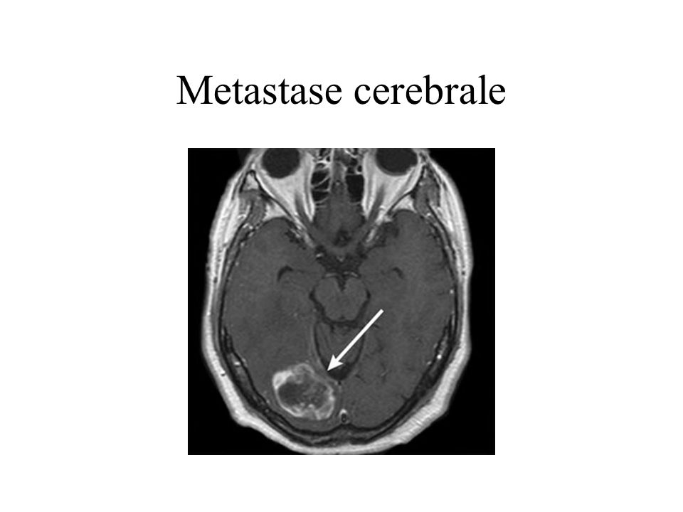 Metastase cerebrale