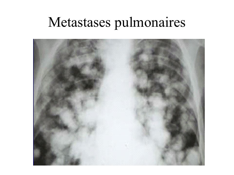 Metastases pulmonaires