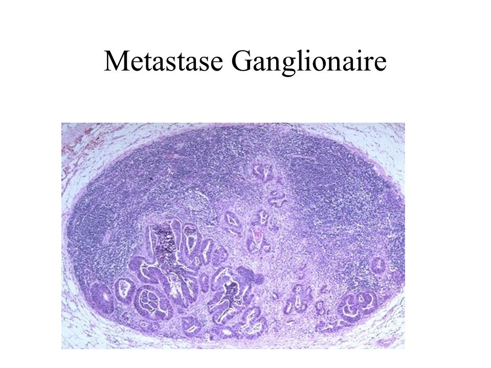 Metastase Ganglionaire