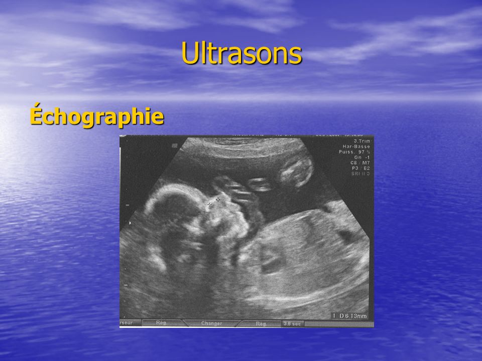 Ultrasons Échographie