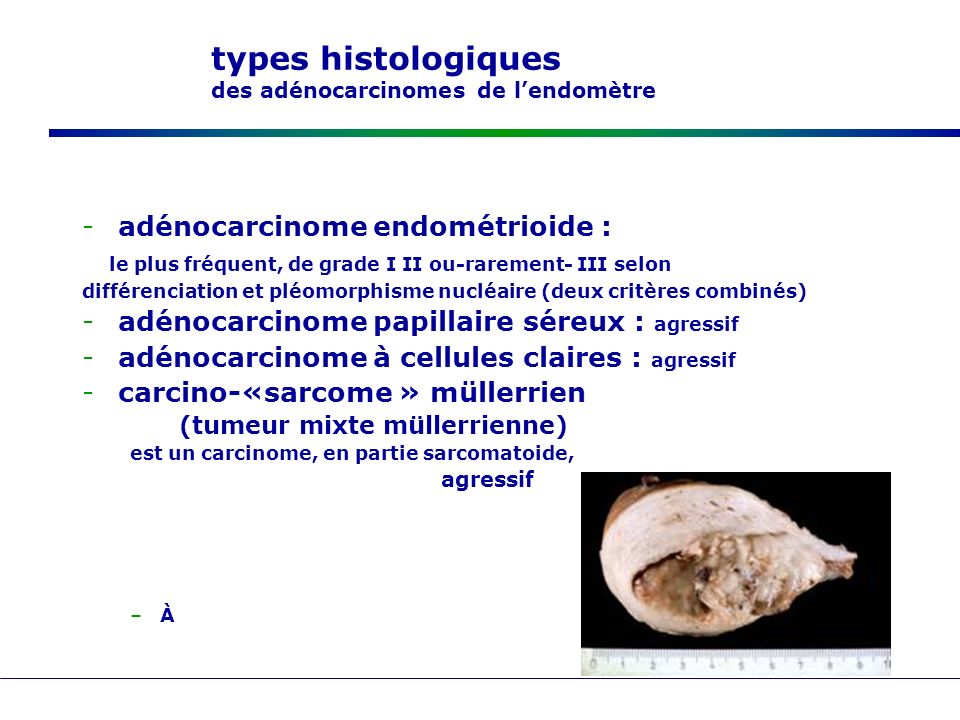 types histologiques des adénocarcinomes de l’endomètre