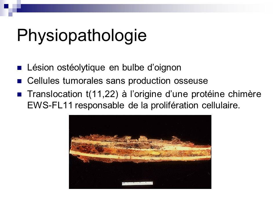 Physiopathologie Lésion ostéolytique en bulbe d’oignon