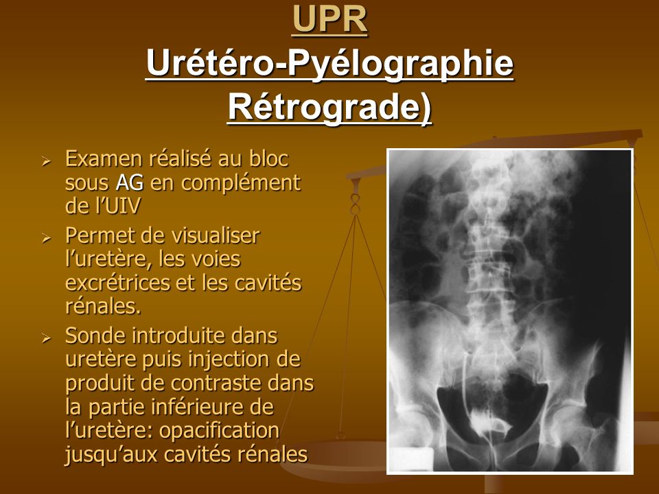 UPR Urétéro-Pyélographie Rétrograde)‏