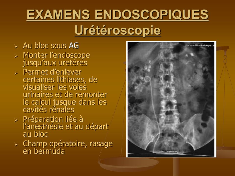 EXAMENS ENDOSCOPIQUES Urétéroscopie