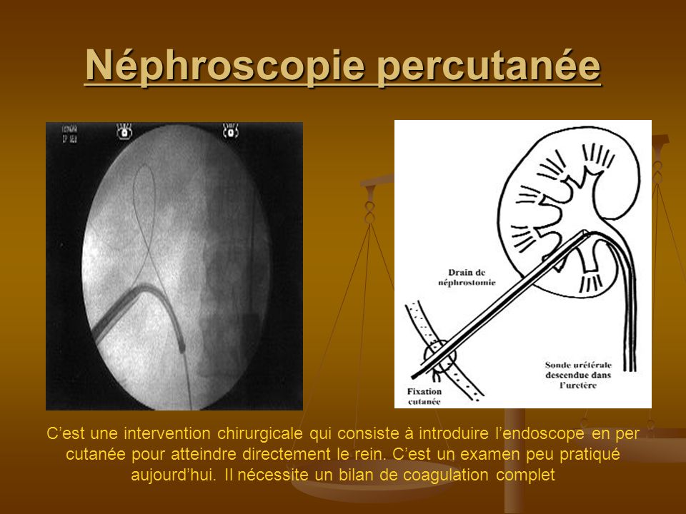 Néphroscopie percutanée