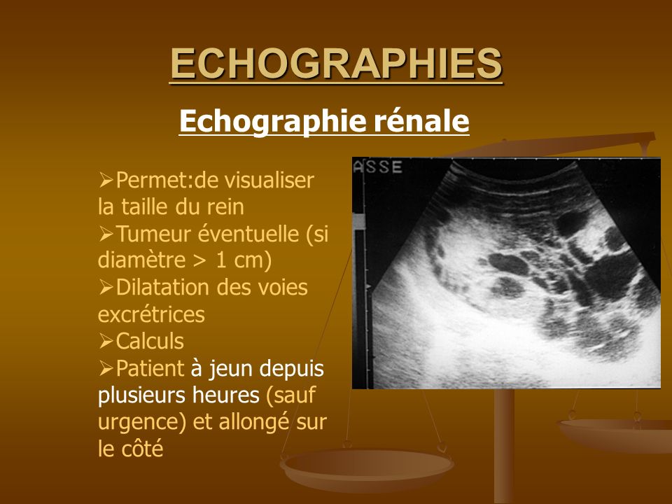 ECHOGRAPHIES Echographie rénale Permet:de visualiser la taille du rein