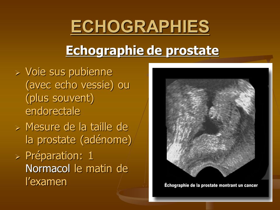 ECHOGRAPHIES Echographie de prostate