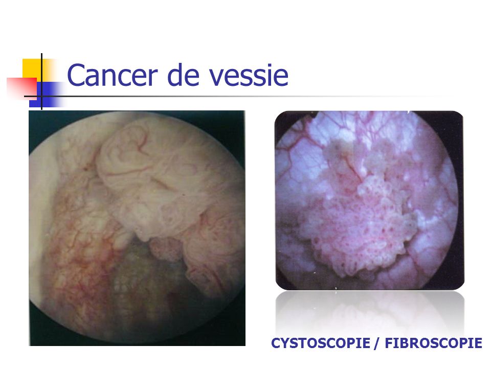 Cancer de vessie CYSTOSCOPIE / FIBROSCOPIE