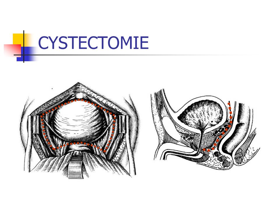 CYSTECTOMIE
