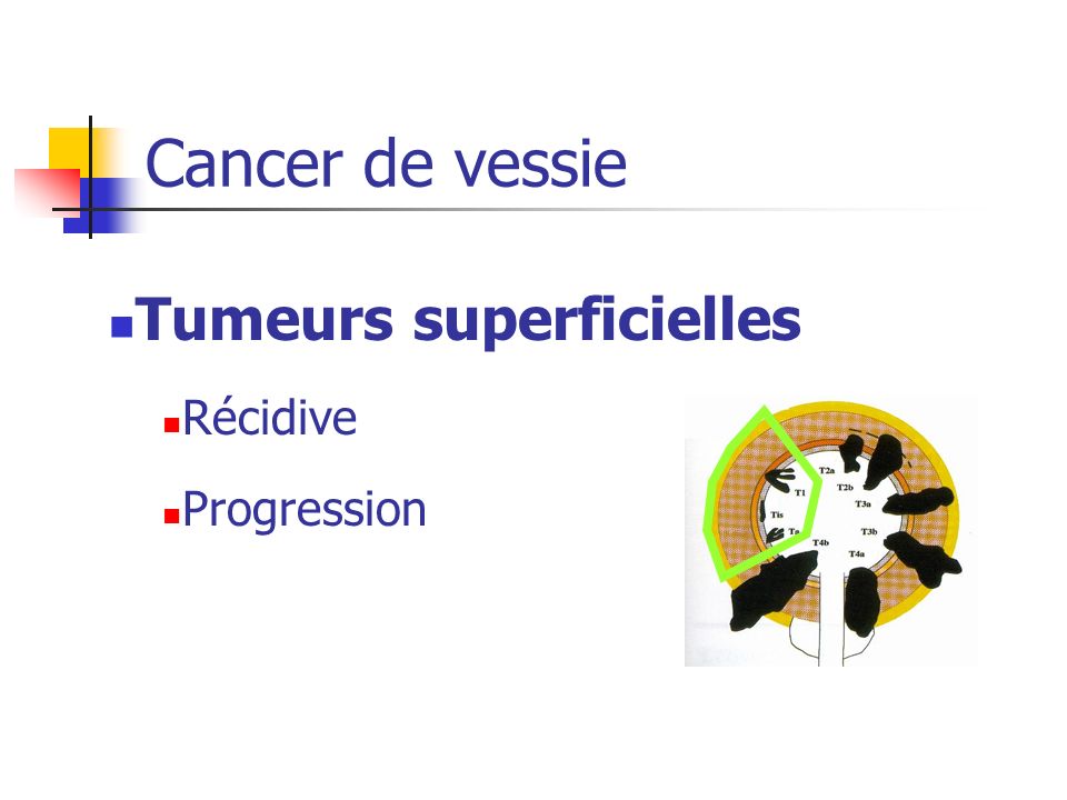 Cancer de vessie Tumeurs superficielles Récidive Progression