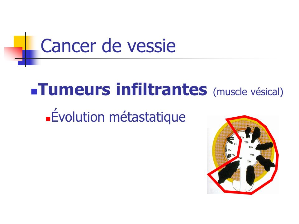 Cancer de vessie Tumeurs infiltrantes (muscle vésical)
