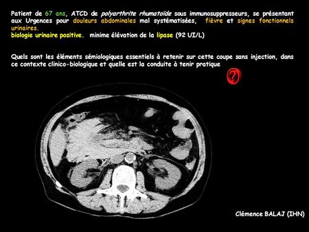 Patient de 67 ans, ATCD de polyarthrite rhumatoïde sous immunosuppresseurs, se présentant aux Urgences pour douleurs abdominales mal systématisées, fièvre.