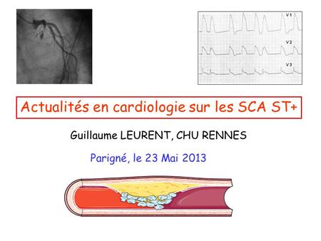 Actualités en cardiologie sur les SCA ST+