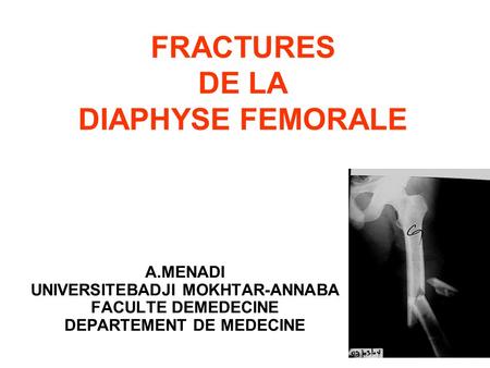 FRACTURES DE LA DIAPHYSE FEMORALE