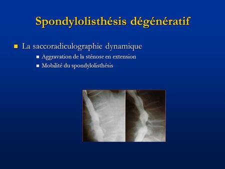 Spondylolisthésis dégénératif