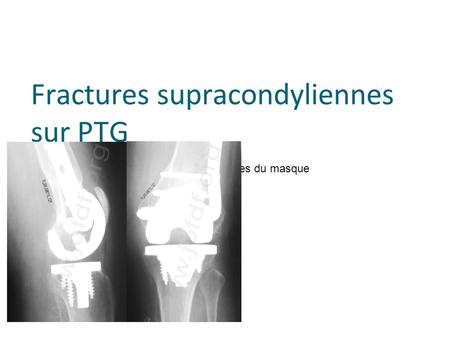 Cliquez pour modifier le style des sous-titres du masque Fractures supracondyliennes sur PTG Jean-Alain Epinette Bruay-Labuissière.