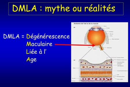 DMLA : mythe ou réalités