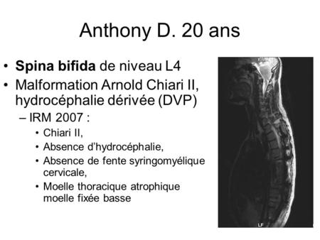 Anthony D. 20 ans Spina bifida de niveau L4