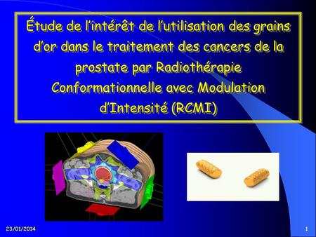 Étude de l’intérêt de l’utilisation des grains d’or dans le traitement des cancers de la prostate par Radiothérapie Conformationnelle avec Modulation d’Intensité.