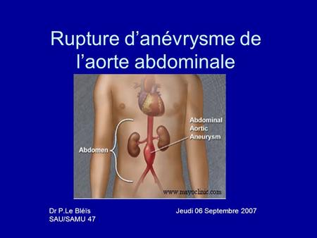 Rupture d’anévrysme de l’aorte abdominale