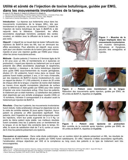 Utilité et sûreté de l’injection de toxine botulinique, guidée par EMG, dans les mouvements involontaires de la langue. A.Lozza (1), F.C. Wang (2), C.