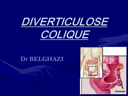 DIVERTICULOSE COLIQUE