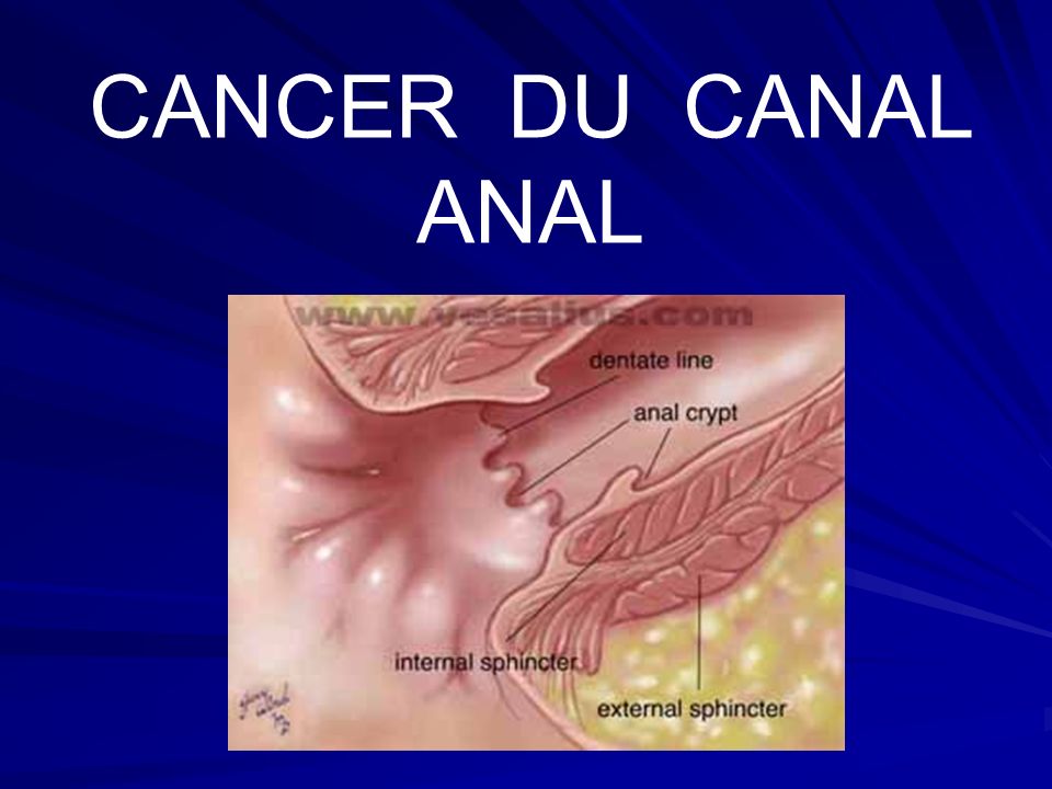 Quels sont les symptômes du cancer de l'anus (canal anal)