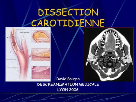 DISSECTION CAROTIDIENNE