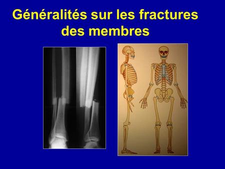 Généralités sur les fractures des membres