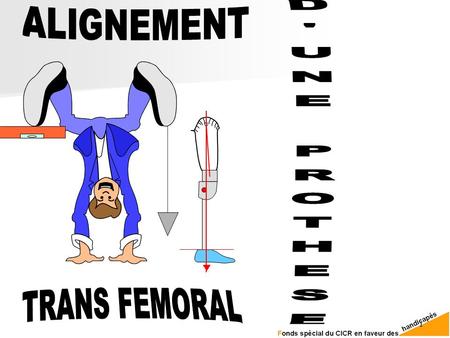 ALIGNEMENT D'UNE PROTHESE TRANS FEMORAL.