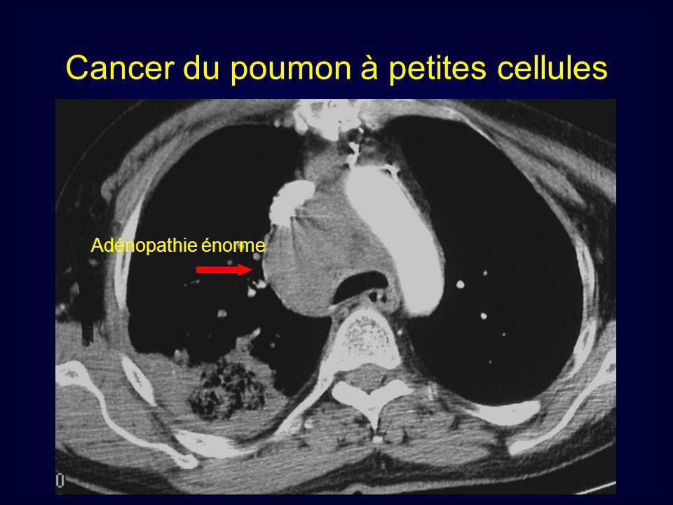 cancer pulmonaire d'origine professionnelle