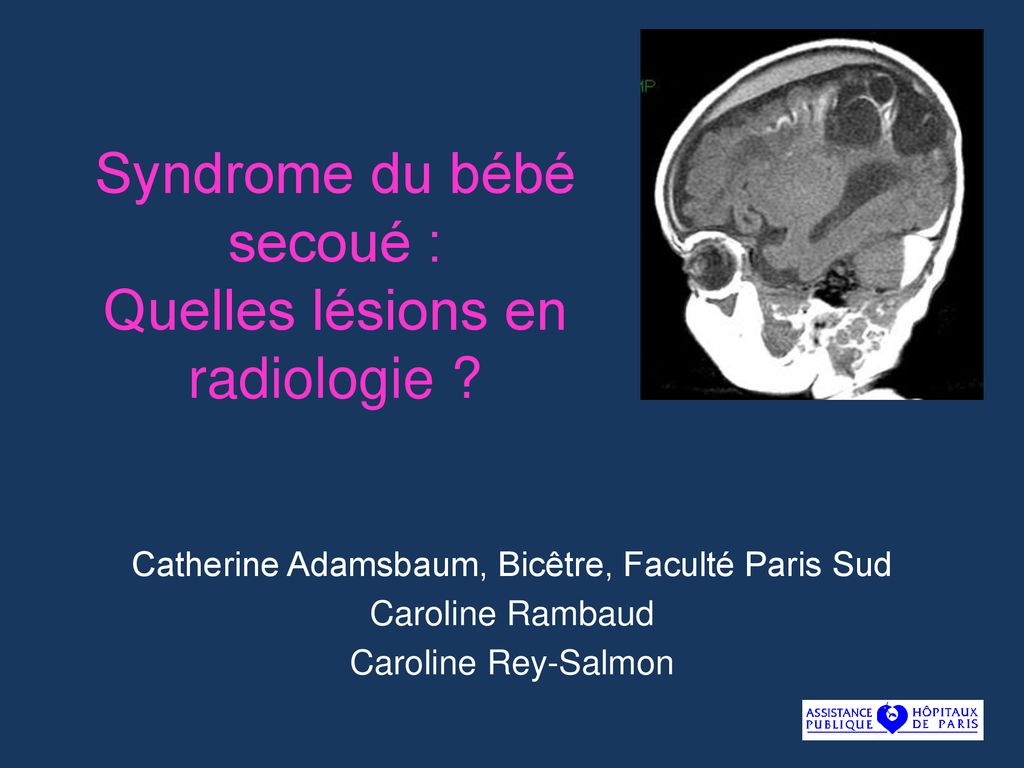 Syndrome Du Bebe Secoue Quelles Lesions En Radiologie Ppt Telecharger