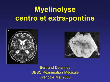 Myelinolyse centro et extra-pontine