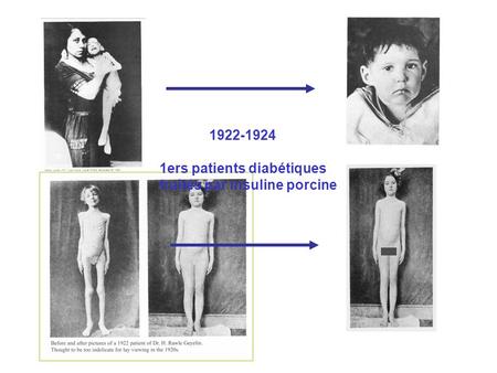 1922-1924 1ers patients diabétiques traités par insuline porcine.