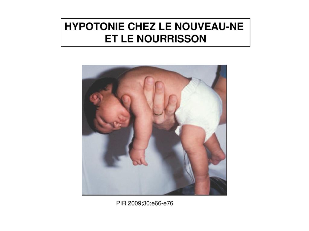 Hypotonie Benigne Nourrisson