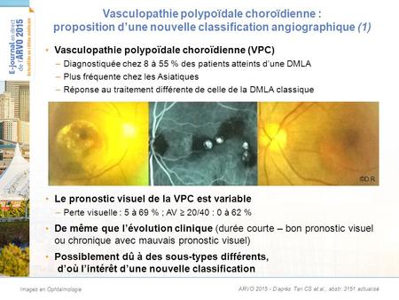 Vasculopathie polypoïdale choroïdienne : une nouvelle classification angiographique (2) Étude interventionnelle longitudinale de validation (5 ans) réalisée à Singapour.