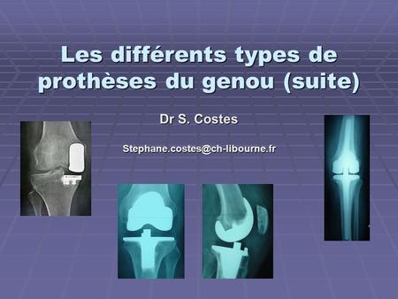 Les différents types de prothèses du genou (suite)