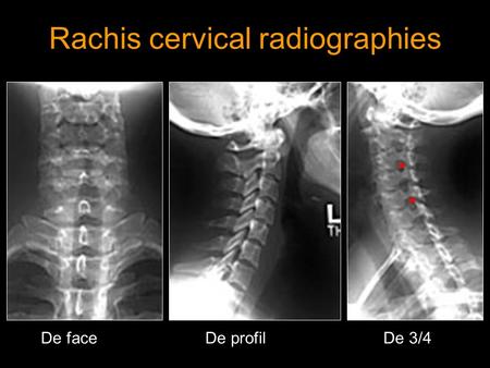 Rachis cervical radiographies