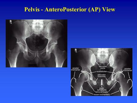 Pelvis - AnteroPosterior (AP) View