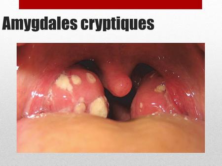 Amygdales cryptiques.
