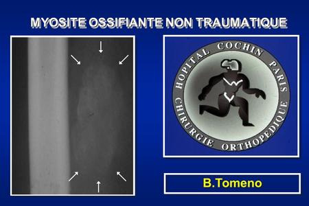 MYOSITE OSSIFIANTE NON TRAUMATIQUE B.Tomeno. Définition: Métaplasie osseuse localisée (circonscrite) idiopathique A distinguer de: Myosite ossifiante.