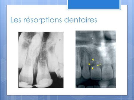 Les résorptions dentaires
