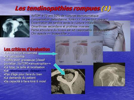 Les tendinopathies rompues (1) AoTDM à 70 ans 50% de ruptures asymptomatique Compensation deltoïdienne, Kiné+++ ne pas tout opérer!! Excentration est tardive.