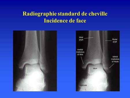 Radiographie standard de cheville Incidence de face