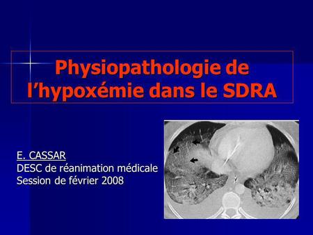 Physiopathologie de l’hypoxémie dans le SDRA