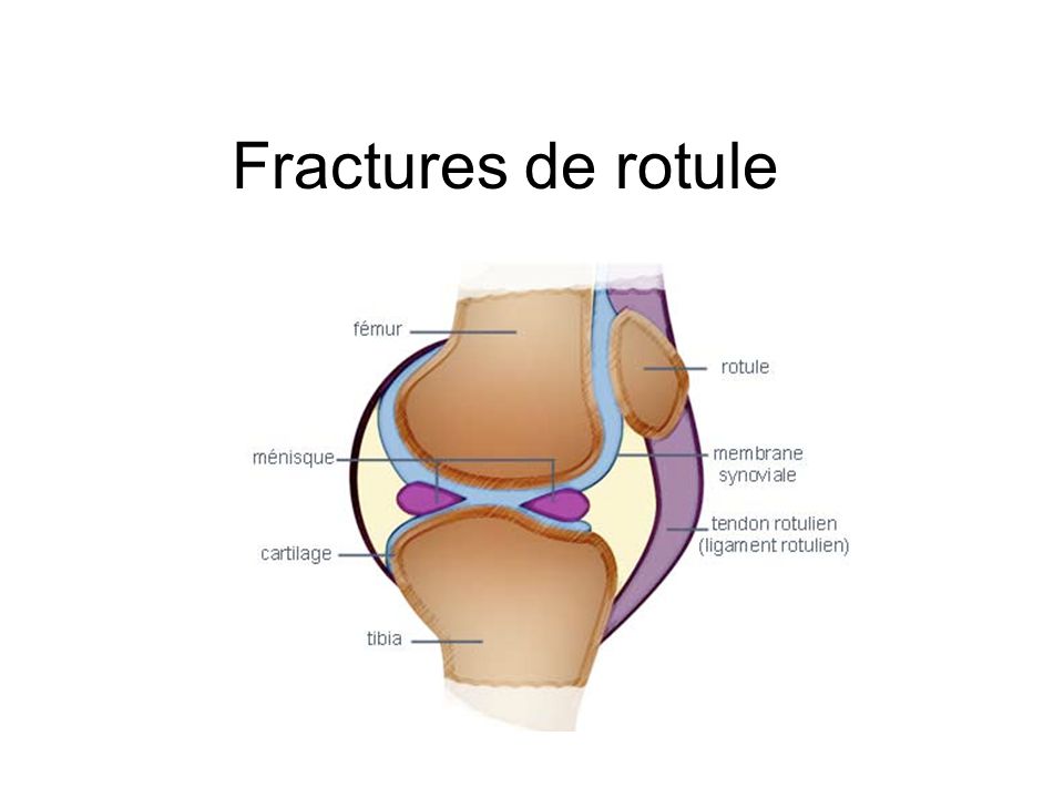 Fracture de Rotule